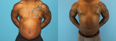 Liposuction case #5966