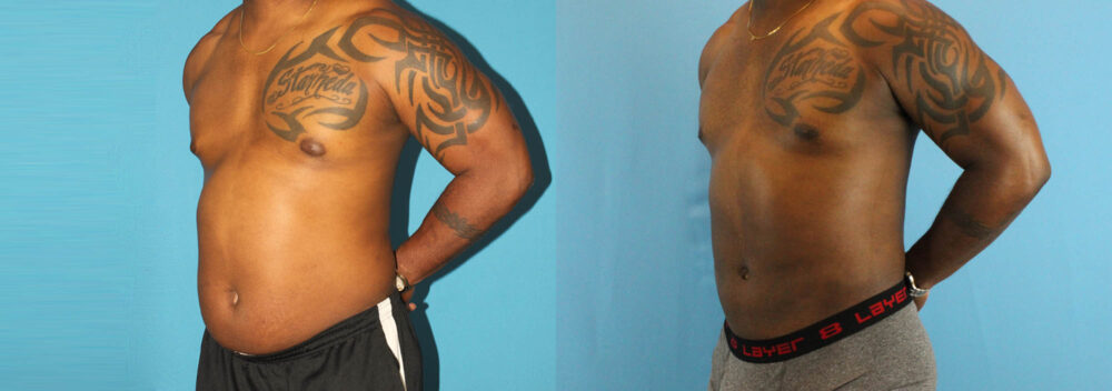 Liposuction case #5966