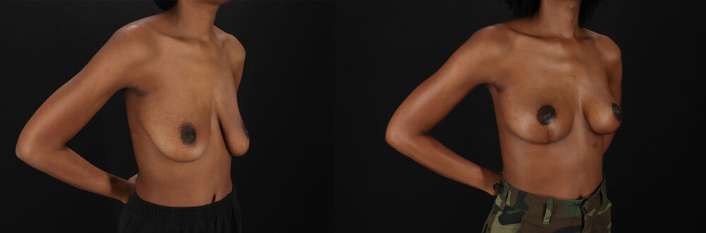 Breast Lift case #7806