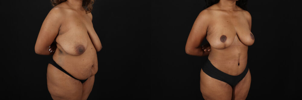 Post Bariatric Surgery (Massive Weight Loss) case #6782