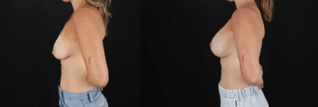 Breast Lift with Implants case #7903