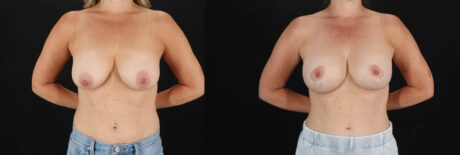 Breast Lift with Implants case #7903