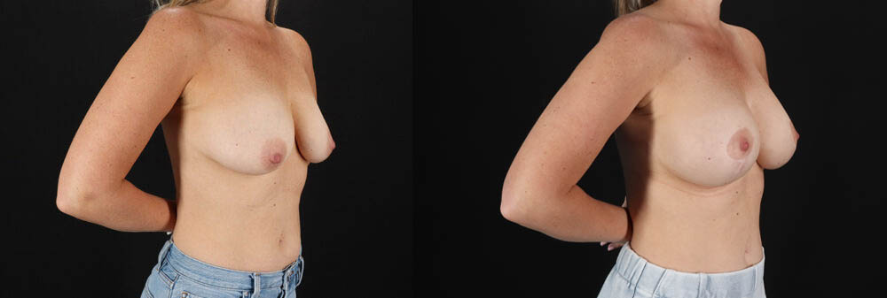 Breast Lift with Implants case #7903
