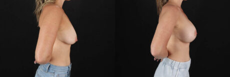 Breast Lift with Implants case #7903