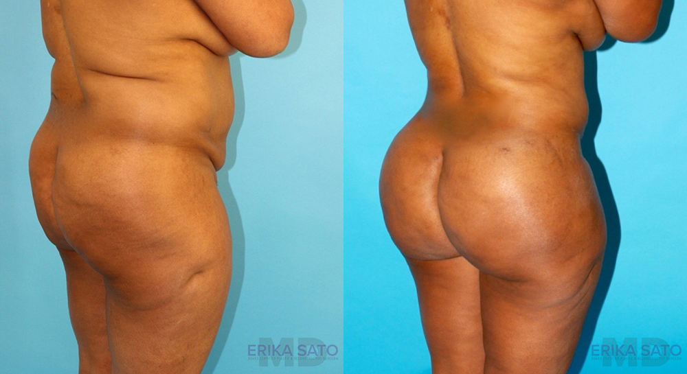 Brazilian Butt Lift case #4452