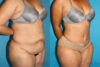 Tummy Tuck case #7226 slider thumbnail
