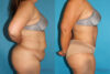 Tummy Tuck case #7226 slider thumbnail