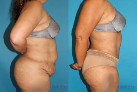 Tummy Tuck case #7226