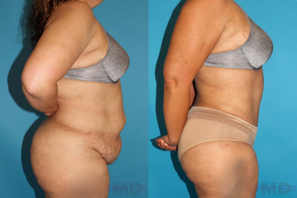 Tummy Tuck case #7226