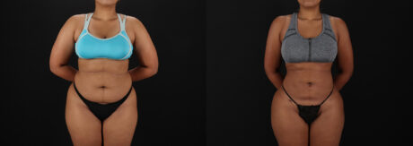 Brazilian Butt Lift case #5513