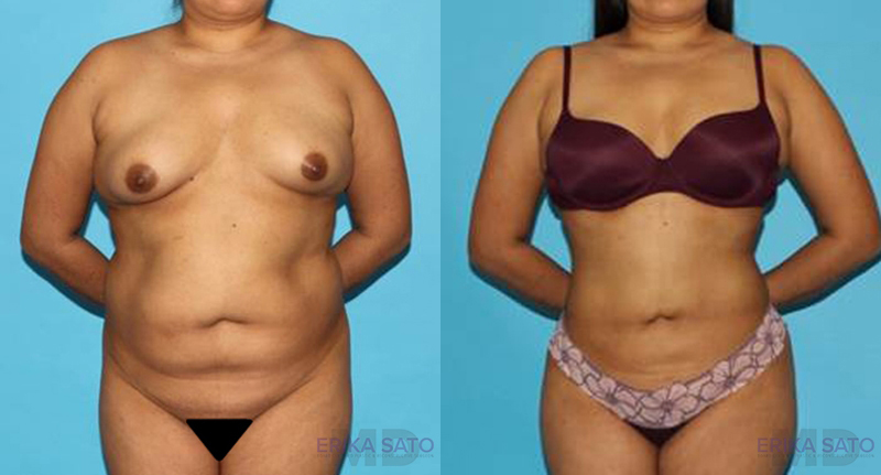 Brazilian Butt Lift case #4495