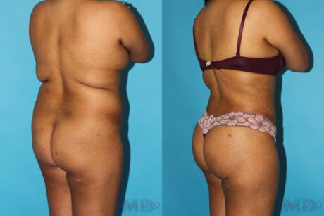 Brazilian Butt Lift case #4495