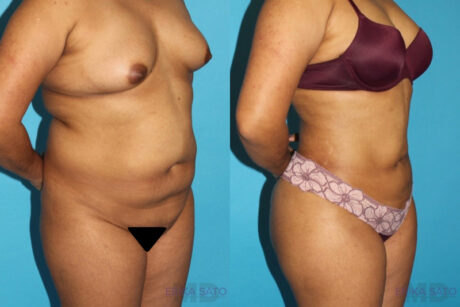 Brazilian Butt Lift case #4495