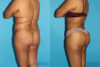 Brazilian Butt Lift case #4495 slider thumbnail