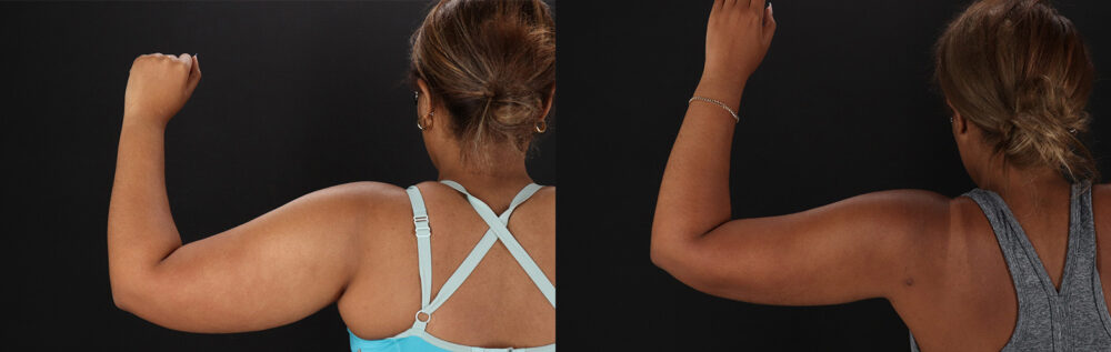 Brazilian Butt Lift case #5513