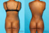 Brazilian Butt Lift case #4640 slider thumbnail