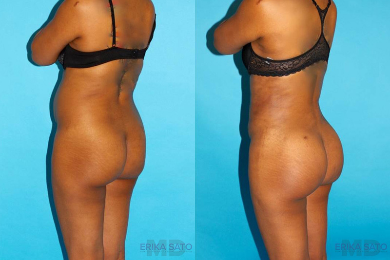 Brazilian Butt Lift case #4640