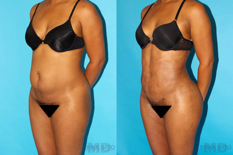 Brazilian Butt Lift case #4640