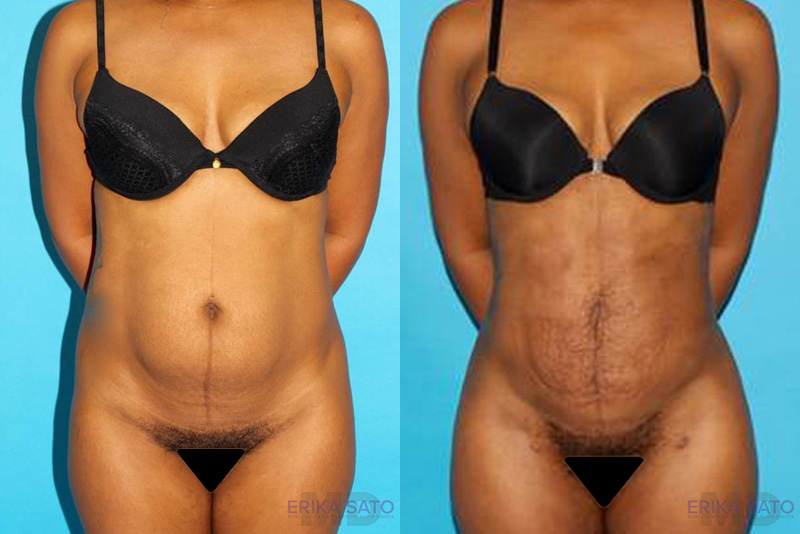 Brazilian Butt Lift case #4640