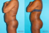 Brazilian Butt Lift case #4634 slider thumbnail