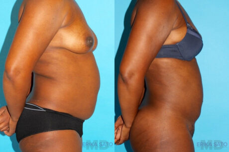 Brazilian Butt Lift case #4634