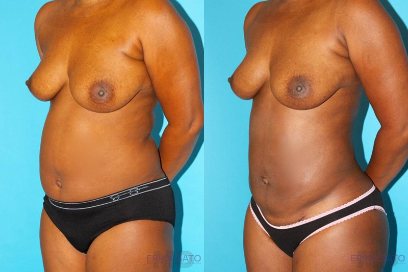Brazilian Butt Lift case #4634