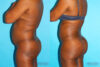 Brazilian Butt Lift case #4634 slider thumbnail