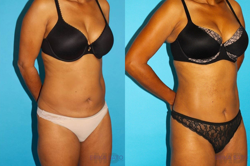 Tummy Tuck case #7232