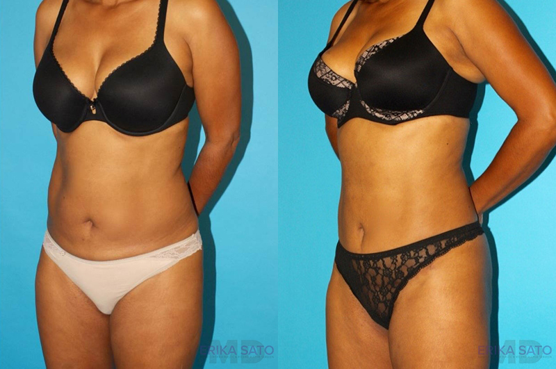 Tummy Tuck case #7232