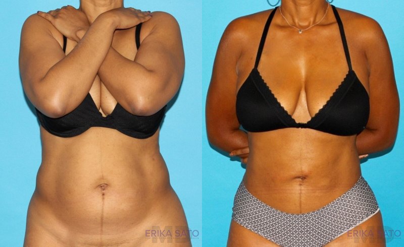 Liposuction case #5884