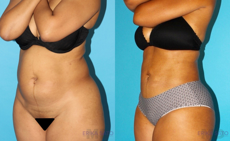 Liposuction case #5884