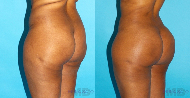 Brazilian Butt Lift case #4674