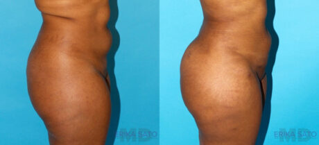 Brazilian Butt Lift case #4674