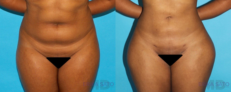 Brazilian Butt Lift case #4674