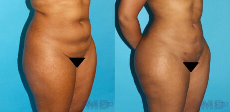 Brazilian Butt Lift case #4674