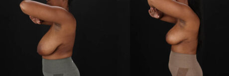 Breast Reduction case #8031