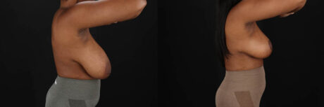 Breast Reduction case #8031