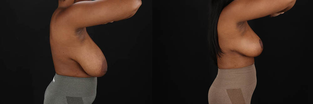 Breast Reduction case #8031