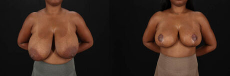 Breast Reduction case #8031