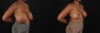 Breast Reduction case #8031 slider thumbnail