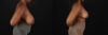 Breast Reduction case #8031 slider thumbnail