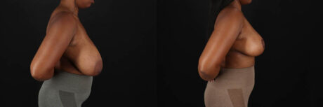 Breast Reduction case #8031