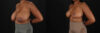 Breast Reduction case #8031 slider thumbnail