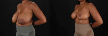 Breast Reduction case #8031