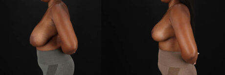 Breast Reduction case #8031