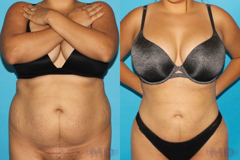 Brazilian Butt Lift case #4752