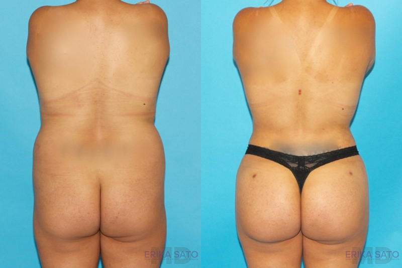 Brazilian Butt Lift case #4752
