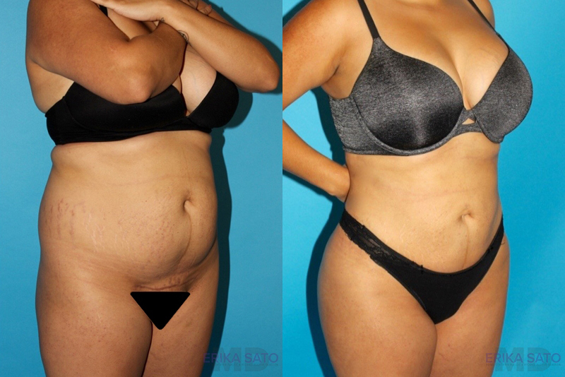 Brazilian Butt Lift case #4752