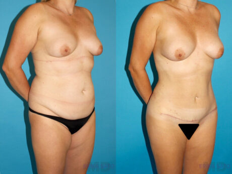 Mommy Makeover case #6505