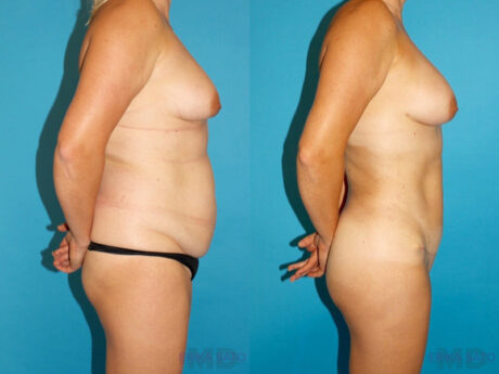 Mommy Makeover case #6505